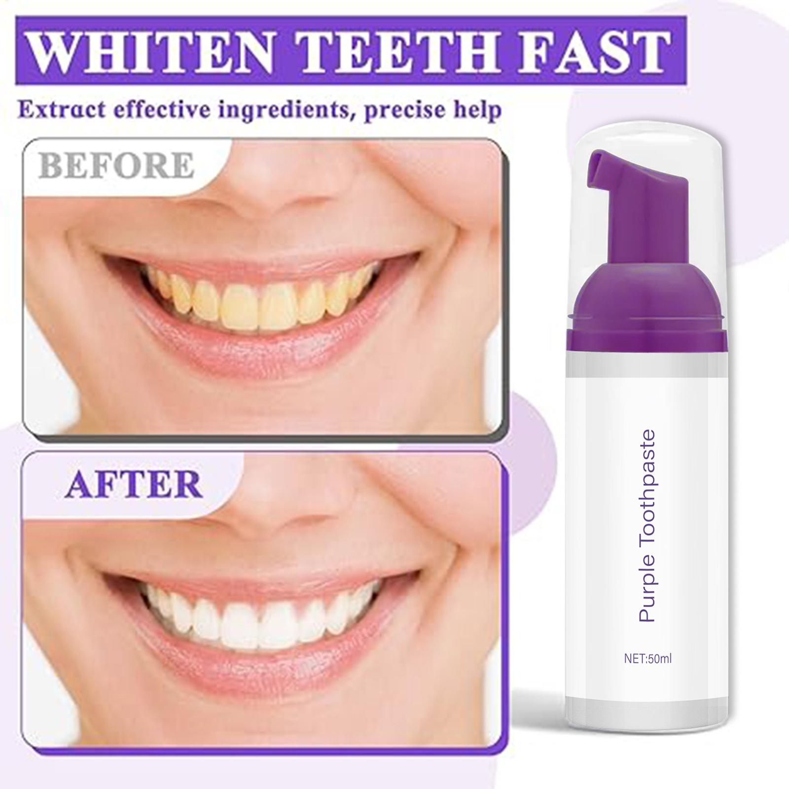 Teeth Whitening Before And After - Pasta de Dente em Espuma 50ml: