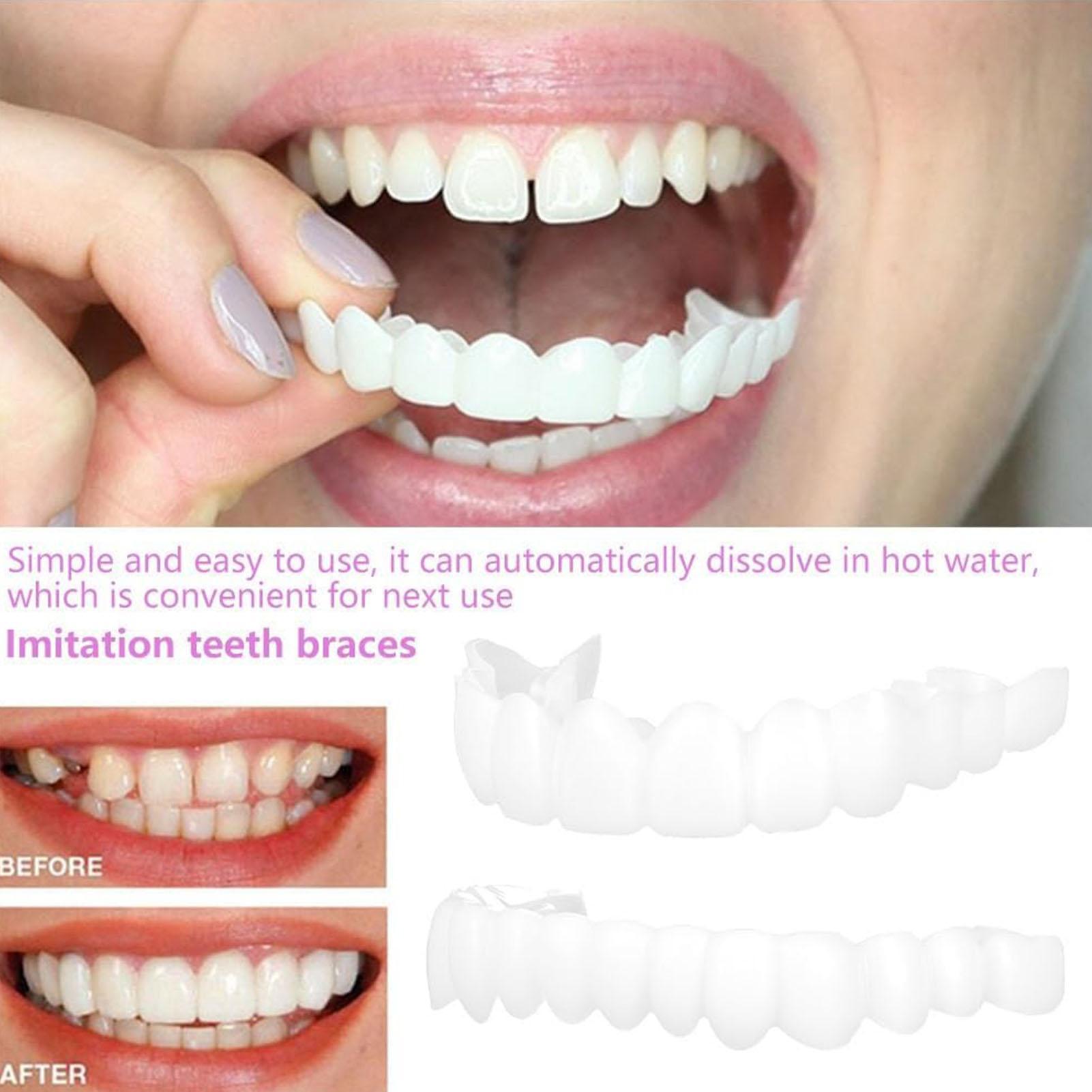 Capa Dentária Superior e Infer - Teeth Whitening Veneers avaliação e preço