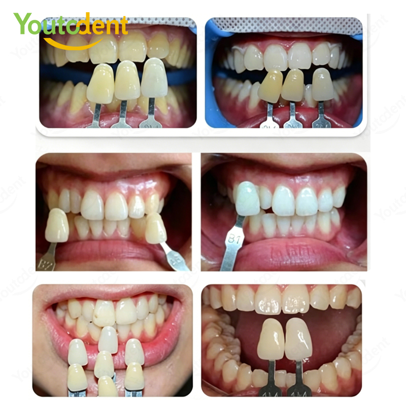 Guia de Cores para Clareamento - Teeth Whitening Before And After avaliação e preço