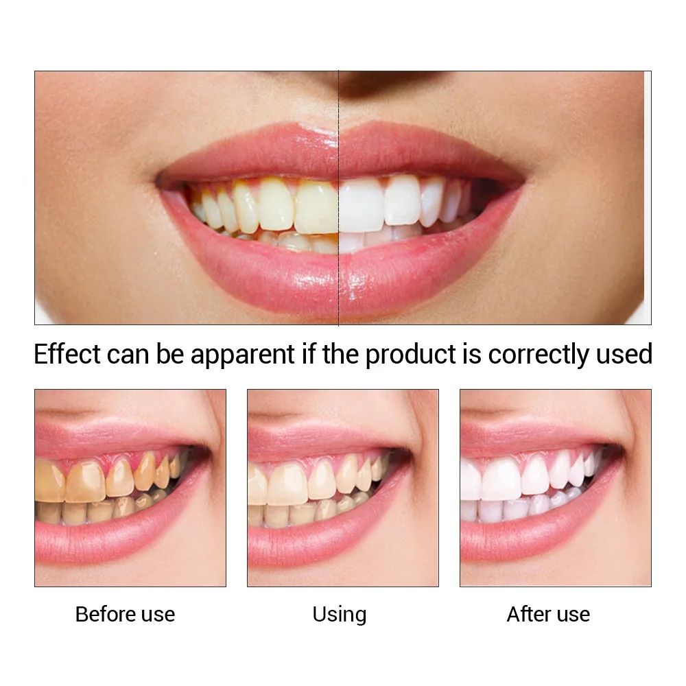 FTEENPLY Essência para claream - Teeth Whitening Results avaliação e preço