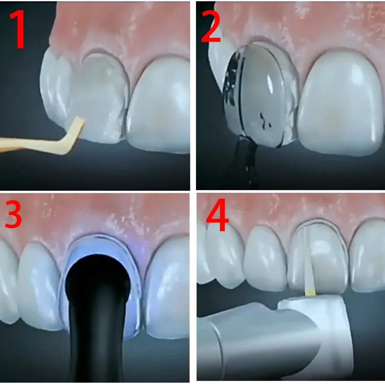2 conjuntos de kit de molde de - Teeth Whitening Moulds avaliação e preço