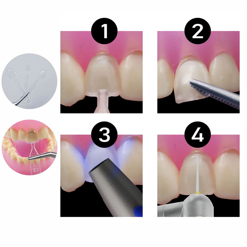 Kit de Moldes de Resina Compos - Teeth Whitening Moulds avaliação e preço