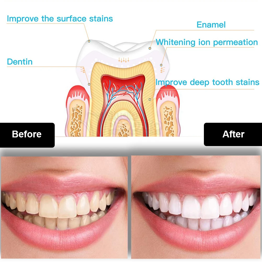Kit de clareamento dental dos  - Teeth Whitening Results avaliação e preço