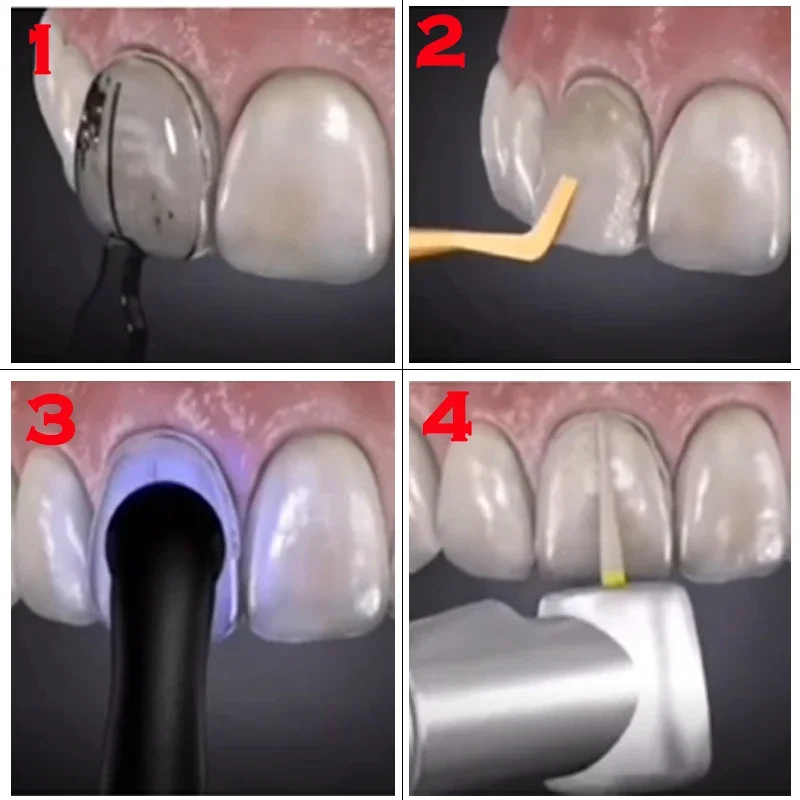 Molde Odontológico para Faceta - Teeth Whitening Moulds avaliação e preço