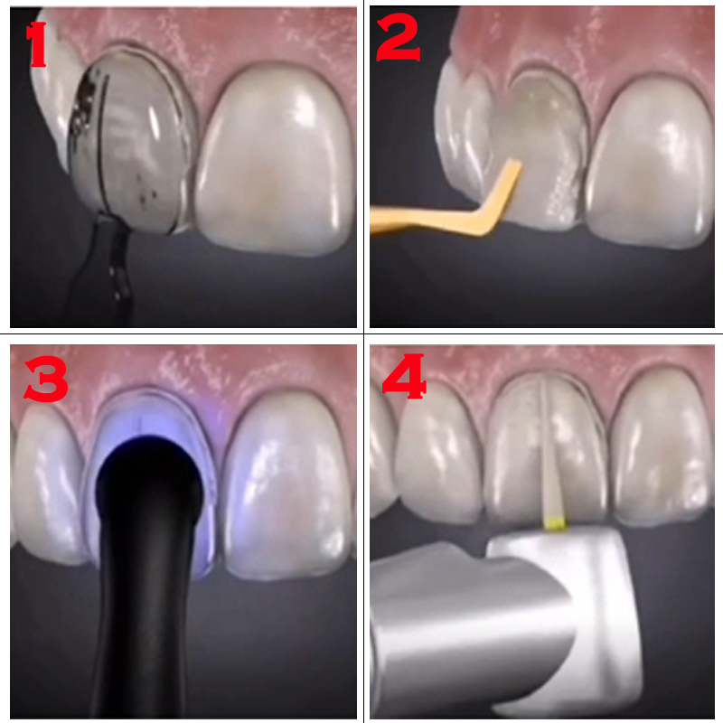 Kit de Moldes para Facetas Den - Teeth Whitening Moulds avaliação e preço