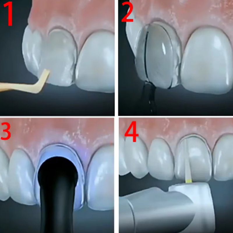 Kit de Molde De Folheado Dentá - Teeth Whitening Moulds avaliação e preço